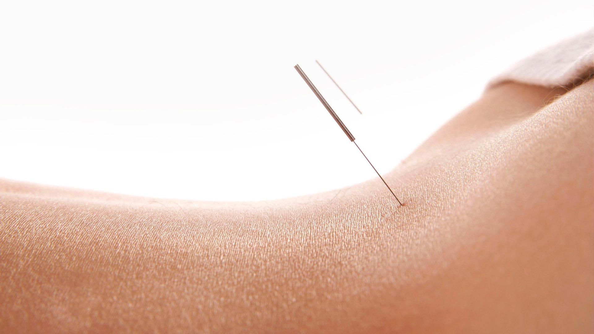 fisioterapia_marbella_acupuntura