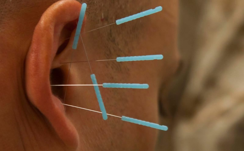 AURICULOTERAPIA