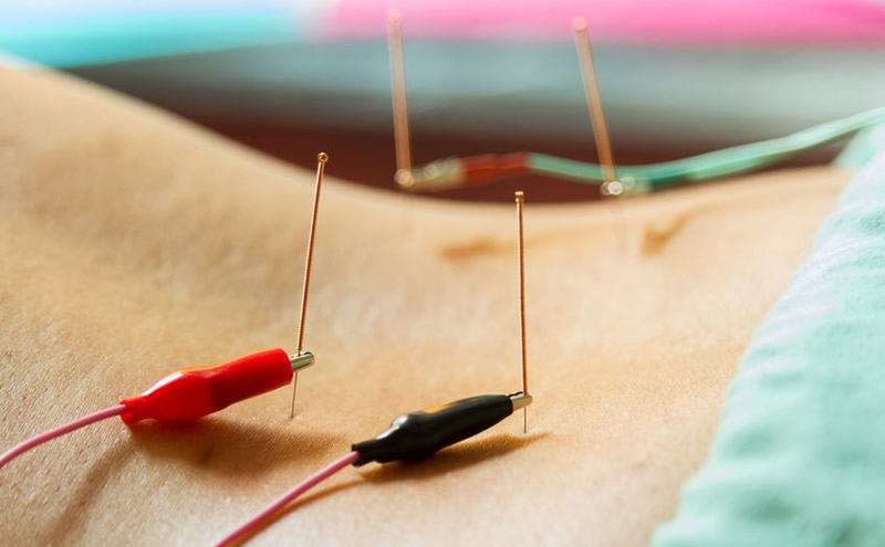 ELECTROACUPUNTURA